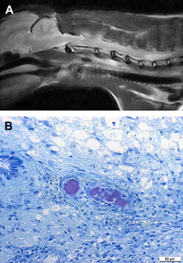 Эмболия волокнистым хрящом у 9-летней ДКШ кошки. (А) Сагиттальное Т2-взвешенное изображение каудальной части шейного отдела спинного мозга