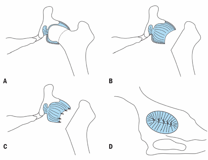 Капсулу сустава располагали в промежутке между участком остеотомии и вертлужной впадиной во избежа- ние боли из-за контакта двух костных поверхностей.