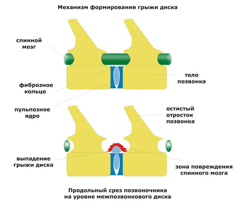 Механизм образования Intervertebral Disk Disease (IVDD) Тип 1 Hansen. Разрыв фиброзного кольца, смещение вещества диска в спинномозговой канал. Продольный срез