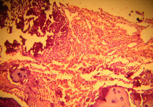 Грыжа диска в ткани гиалинового хряща обширные некрозы, кровоизлияния, очаги кальциноза у таксы