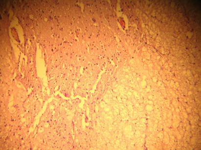 Спиной мозг  в области грыжи диска атрофия оболочек  дистрофические изменения в клетках гибель некоторых клеток
