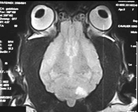 МРТ-снимок мозга ККЧС с клиновидным инфарктом мозжечка в нижней правой части мозга. 