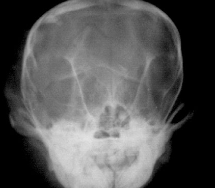 Рентгенограмма: перелом костей черепа у йорка. Фронтальная проекция.