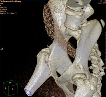 Образование свободных фрагментов на дорсальном крае головки бедренной кости в результате перелома