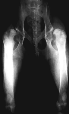 Корригирующая остеотомия бедренной кости. Данную операцию проводят при вальгусной антеторсии бедренной кости