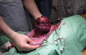 На фото опухоль яичника, вызвавшая асцит