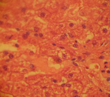 Гистология. Резко выраженный гидропическая дистрофия и колликвационный некроз гепатоцитов