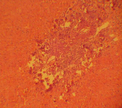Массивный некроз паренхимы с кровоизлияниями, очаговая пролиферация грануляционной ткани, сохранившиеся гепатоциты с явлениями  белковой дистрофии (фульминантная форма гепатита)