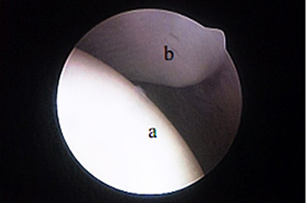 Каудальная часть головки плечевой кости (а) и суставная впадина лопатки (b)