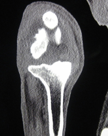 КТ коленного сустава, лабрадор 1.5 года. Результат лечения расслаивающего остеохондрита глюкокортикоидами. Поднадкостничный склероз медиального мыщелка бедренной кости и плато большеберцовой кости.