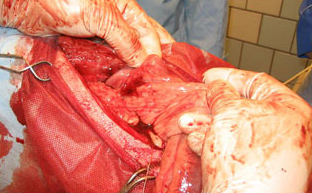 Кровоизлияние в область поджелудочной железы