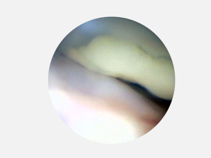 Полость коленного сустава лабрадора 3-х лет. Фрагмент гноя у собаки в полости сустава