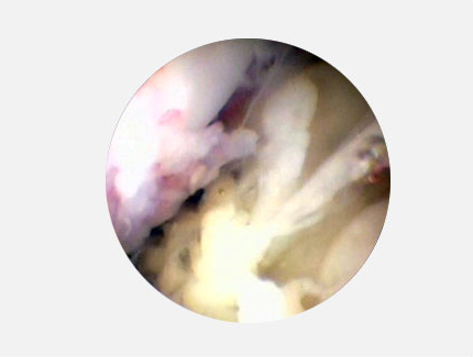 Фрагменты некротизированных тканей в полости коленного сустава лабрадора при гнойном артрите