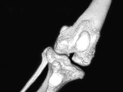 3D КТ. Хорошо видны экзостозы, а также нарушение конгруэнтности костей, образовывающих коленный сустав.