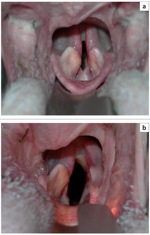 Осмотр гортани у 10-летней мальтийской болонки с параличом гортани: (а) вид до операции и (b) отведение левого черпаловидного хряща после односторонней латерализации.