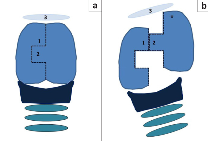 схематическое изображение техники зубчатого продольного разреза гортани, показывающее (а) щитовидный хрящ с вентральной стороны со ступенчатым разрезом и (b) смещение лоскута хряща вперед.