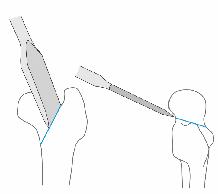 Ориентация остеотома во время остеотомии шейки бедренной кости.