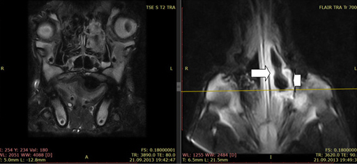 МРТ овчарки с аспергиллезом, хорошо виден в программе FLAIR гиперинтенсивный сигнал