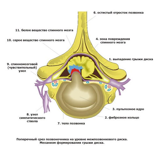 Механизм образования Intervertebral Disk Disease (IVDD) Тип 1 Hansen, разрыв фиброзного кольца, смещение вещества диска в спинномозговой канал. Поперечный срез