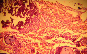 IIVDD в ткани гиалинового хряща у таксы. Обширные некрозы, кровоизлияния, очаги кальциноза