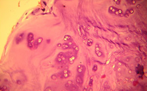 Ядро межпозвонкового диска в области шеи, типический гиалиновый хрящ
