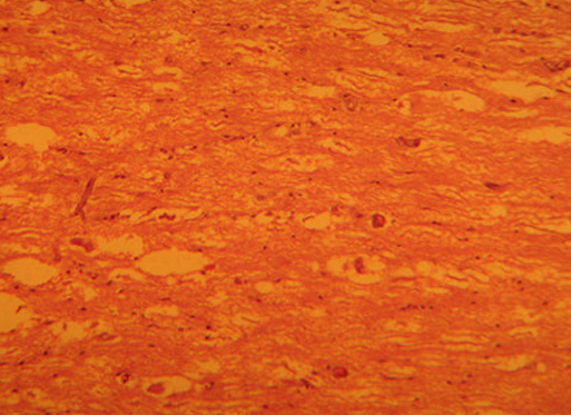 Спинной мозг в области грыжи диска у таксы очаг некробиоза, выраженный отек