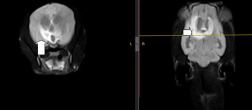 МРТ. Участки гиперинтенсивного сигнала (обозначено стрелкой) показывают наличие воспалительного процесса