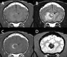 МРТ кровоизлияния в паренхиму правого полушария головного мозга.