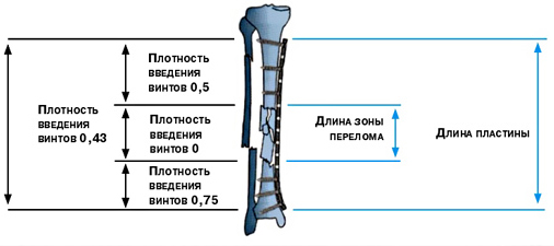 Схема надежной фиксации многооскольчатого диафизарного перелома костей голени