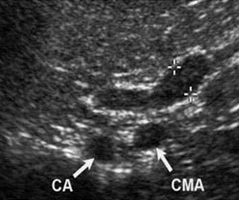 Как найти левый надпочечник: краниальный полюс левого надпочечника находится вентральнее чревной артерии (CA) и краниальной мезентериальной артерии (СМА). Брюшная аорта (Ао) в сагиттальной плоскости расположена вдоль сагиттального среза надпочечника.