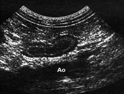 Как найти левый надпочечник: краниальный полюс левого надпочечника находится вентральнее чревной артерии (CA) и краниальной мезентериальной артерии (СМА). Брюшная аорта (Ао) в сагиттальной плоскости расположена вдоль сагиттального среза надпочечника.