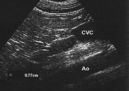Как найти правый надпочечник: расположен параллельно брюшной аорте (Ао) и тесно соединен с каудальной полой веной (CVC)