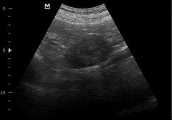 Новообразование левого надпочечника при болезни Кона (продольное и поперечное сканирование). Каудально по отношению к надпочечнику лоцируется просвет брюшной аорты.