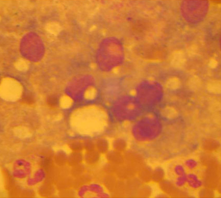Гепатоциты с признаками белковой и жировой дистрофии, наблюдается инфильтрация нейтрофильными лейкоцитами