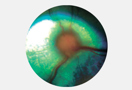  изменения в области диска зрительного нерва