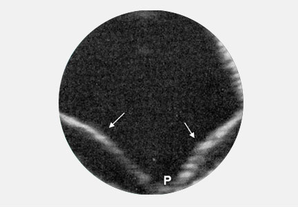 гиперэхогеннfz мембранf, которая соединяется с глазным дном в области диска зрительного нерва, говорит об отслоении сетчатки