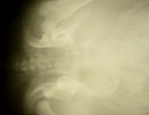 Рентгенограмма для определения дорсального края вертлужной впадины