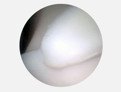 Артроскопическое изображение, на котором виден крупный фрагмент медиальной поверхности венечного отростка у лучевой вырезки