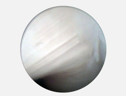 Типичная картина очаговой эрозии медиального мыщелка плечевой кости3-4 степени по Аутербриджу