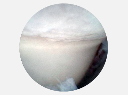 Артроскопическое изображение локтевого сустава 2-летнего ротвейлера через 12 месяцев после скользящей остеотомии плечевой кости