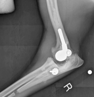 Рентгеновский снимок в медиолатеральной проекции, показывающий типичную картину после полной артропластики локтевого сустава с использованием металлополиэтиленового протеза