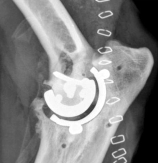 Рентгеновский снимок в медиолатеральной проекции, показывающий типичную послеоперационную картину артропластики локтя с помощью протеза TATE