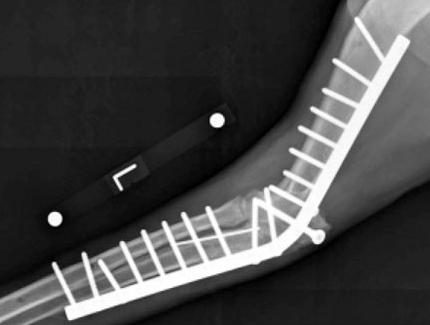 рентгеновский снимок в медиолатеральной проекции, показывающий типичную послеоперационную картину при артродезе локтевого сустава