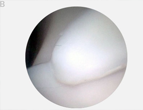 Артроскопическое изображение через 12 недель после операции