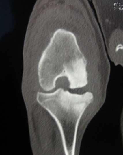 КТ коленного сустава, лабрадор 1.5 года. Результат лечения расслаивающего остеохондрита глюкокортикоидами. Поднадкостничный склероз медиального мыщелка бедренной кости и плато большеберцовой кости.