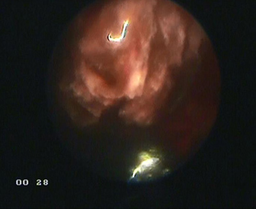По результатам цистоскопии выявлен фиброз мочевого пузыря