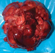 олидный печеночноклеточный рак, показанный на рис. 1, после хирургической резекции 