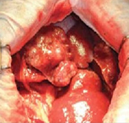 Вид узлового рака желчного протока во время операции. Полная резекция этой опухоли была невозможна из-за поражения нескольких долей печени.