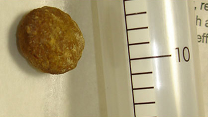 Камень в мочевом пузыре у йоркширского терьера с портокавальным врожденным шунтом