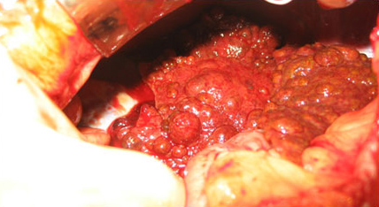 Мульти-монолобулярный постнекротический активный цирроз печени